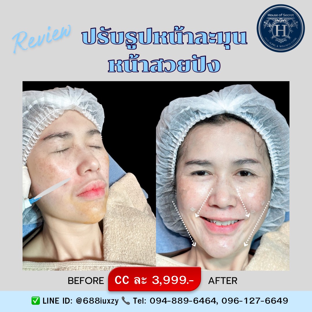 โปรแกรมฟิลเลอร์ ปรับรูปหน้าละมุน 1 cc