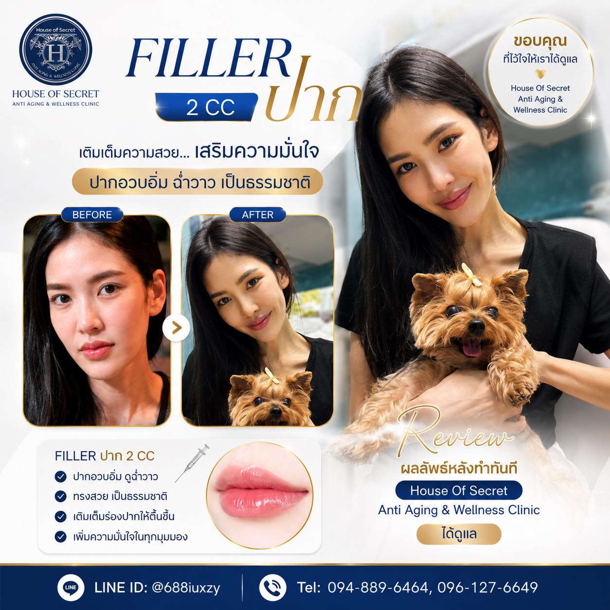 รีวิว ฟิลเลอร์ปาก 2cc