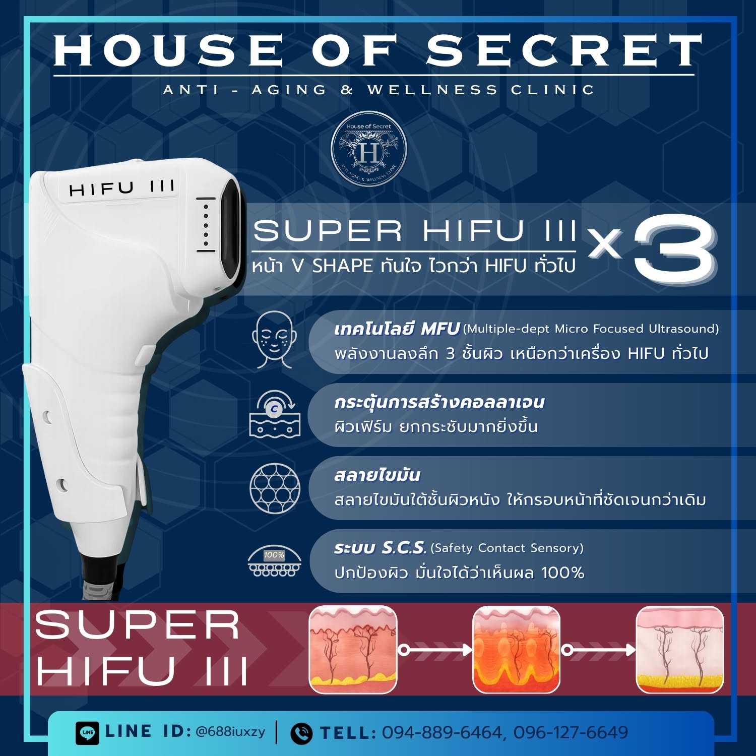 HIFU ไฮฟู่