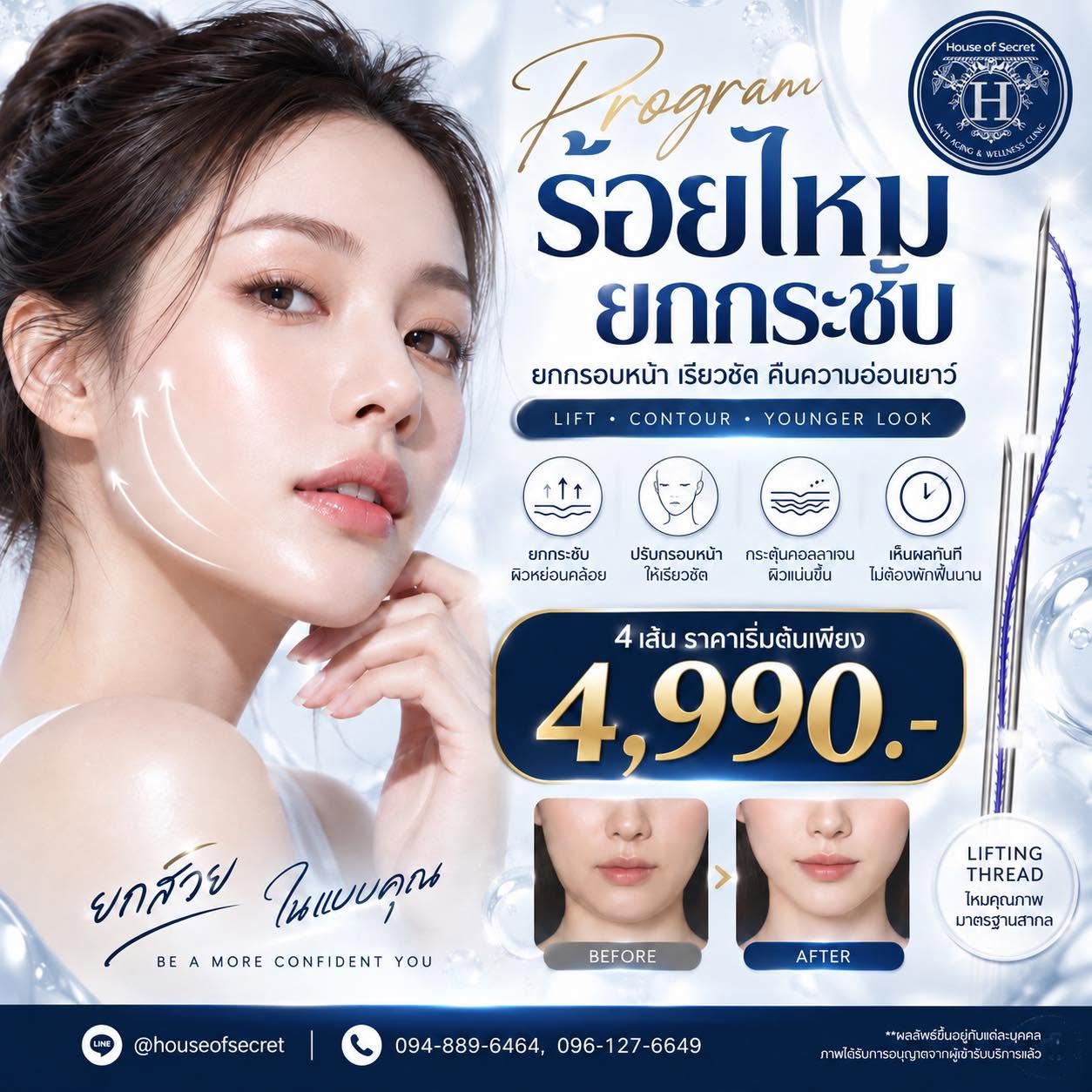 โปรแกรมร้อยไหมยกกระชับ....ให้กรอบหน้าเป็นจุดเด่น…เติมความมั่นใจทุกมุมถ่ายรูป!