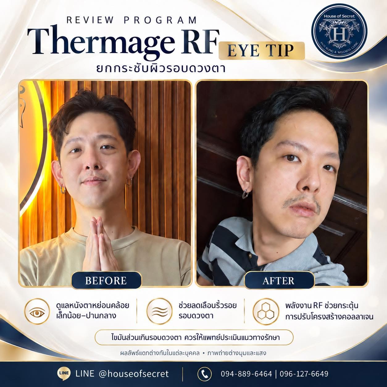 หน้าดูเหนื่อย…ทั้งที่พักเต็มที่? ถึงเวลาดูแลผิวรอบดวงตาให้กลับมาดูสดใส ด้วย โปรแกรม Thermage RF EYE TIP